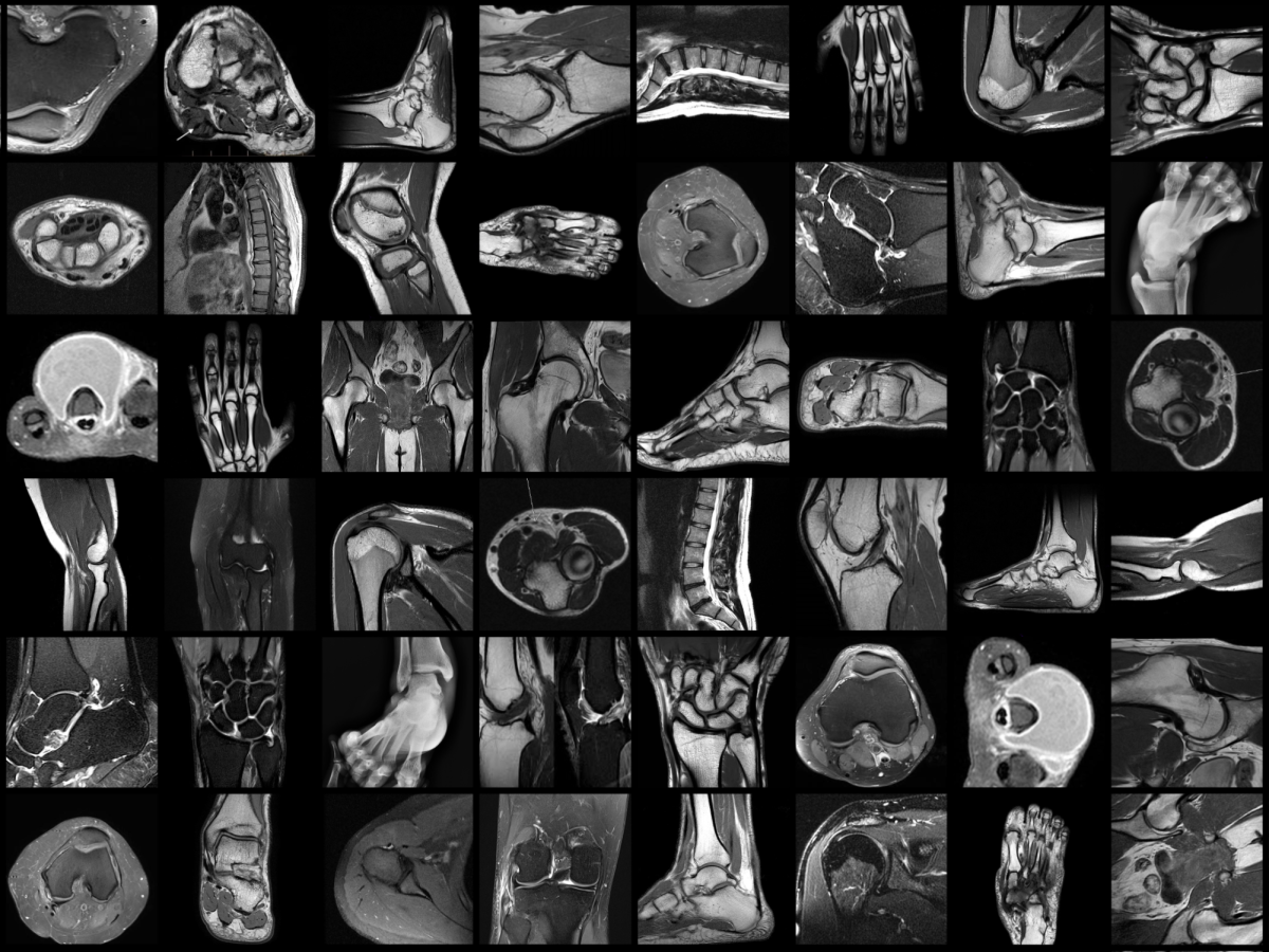 Ligament tears are notorious for their long recovery times and high risk of re-injury. Photos licensed under Creative Commons.